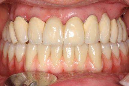 Prothese auf Implantaten